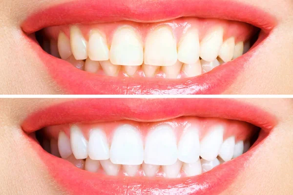 Woman teeth before and after whitening. Over white background — Stock Photo, Image