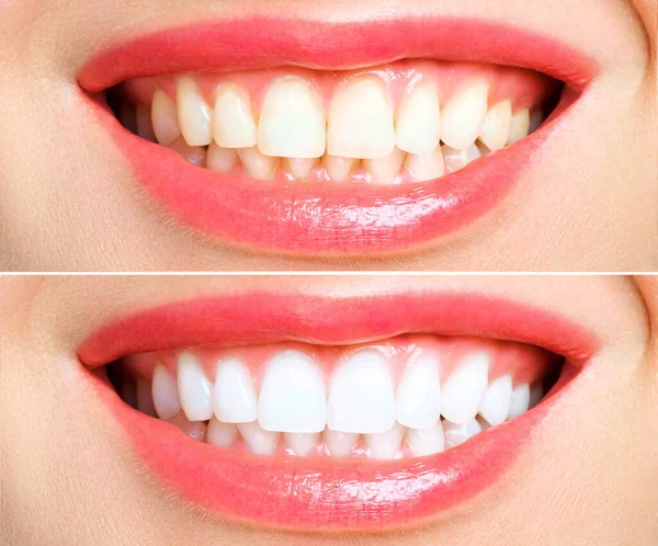 Kadın önce ve sonra beyazlatma dişler. Beyaz arka plan üzerinde - Stok İmaj