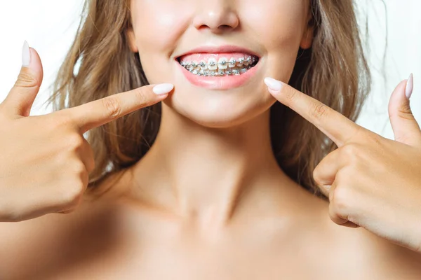 Ortodontisk behandling. Tandvårdskoncept. Vacker kvinna Friska leende närbild. Närbild Keramik och metall fästen på tänder. Vackra kvinnliga leenden med hängslen. — Stockfoto