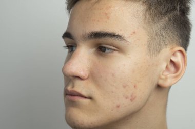 bir genç yüzü sivilce ve siyah nokta kurtulmak için bir çare ile temizler