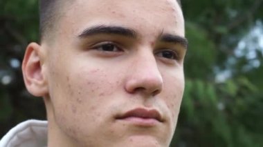 Yüzünde sivilce ve akne olan yüz. Yakından kapatın. Ergen kozmetolojisi ve dermatoloji kavramı