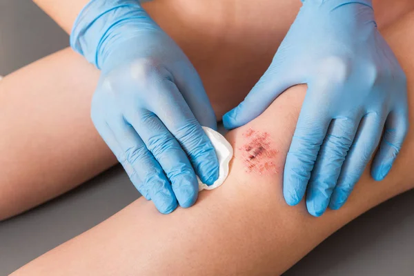 Gewonde Been Wond Knie Met Bloed Artsen Handen Blauwe Medische — Stockfoto