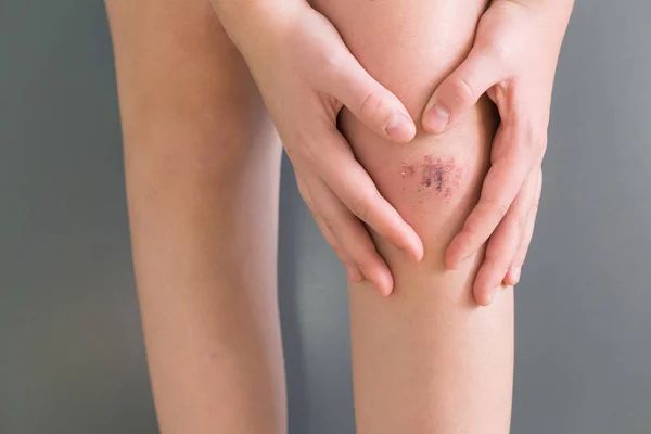 Injured Leg Wound Knee Blood Doctors Hands Treats Patient Treats — Stock Photo, Image