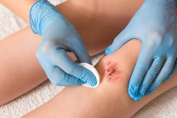 Gewonde Been Wond Knie Met Bloed Artsen Handen Blauwe Medische — Stockfoto