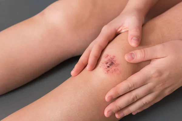 Lutut Terluka Dengan Darah Dan Tangan Dokter Merawat Pasien Merawat — Stok Foto