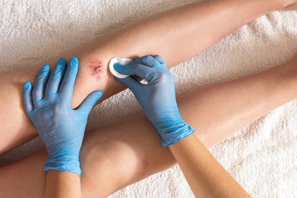 Injured leg wound knee with blood and doctor's hands in blue medical gloves treats a patient, treats a wound