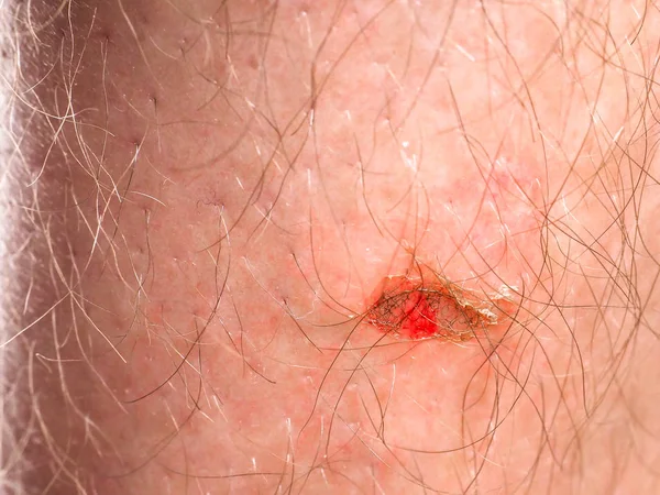 Person Injury Skin Hair — Stock Photo, Image