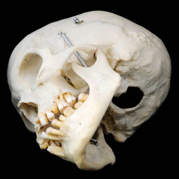Cráneo Humano Real Con Mandíbula Con Bisagras Algunos Dientes Faltantes — Foto de Stock