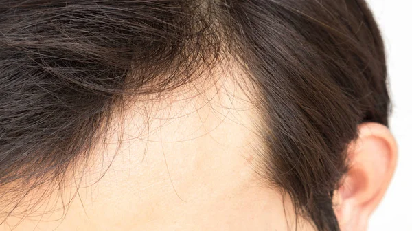 Joven Hombre Serio Problema Pérdida Cabello Para Cuidado Salud Champú — Foto de Stock