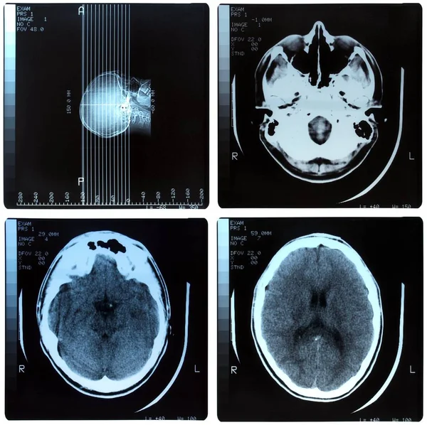 Imagerie Médicale Par Rayons Des Crâne Cerveau Humain — Photo