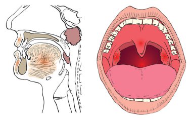 Vector illustration of a disease of the adenoids with the affected agencies. clipart