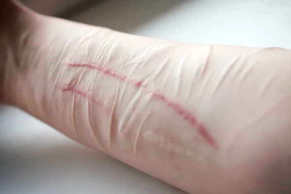 Mão Com Cicatrizes Frescas Velhas Auto Destruidor — Fotografia de Stock