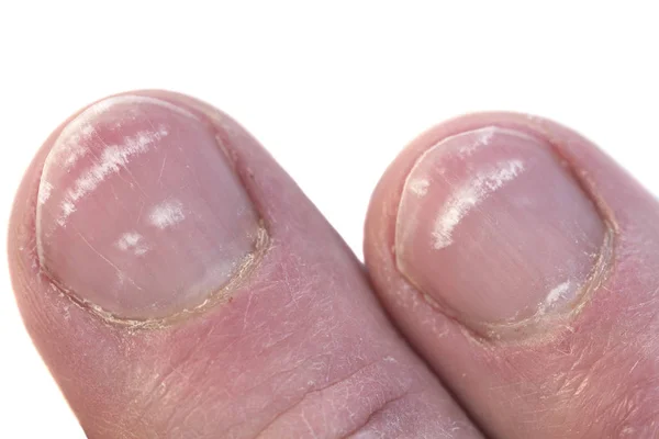 Unhas Fechar Com Condição Chamada Leuconíquia Linhas Brancas Sob Unha — Fotografia de Stock