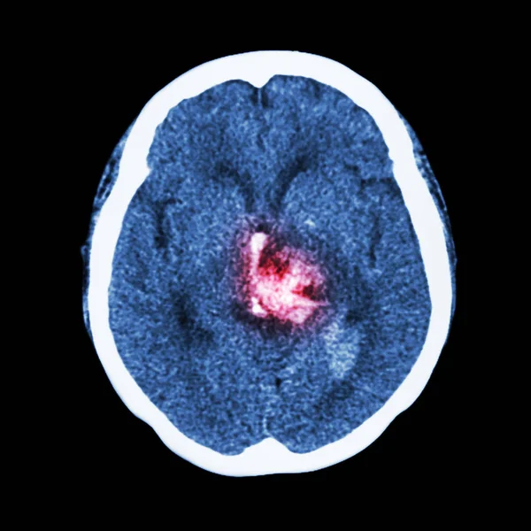Scan Van Hersenen Toon Hemorragische Beroerte — Stockfoto