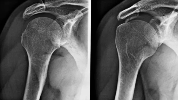 Medyczne Obrazowanie Rentgenowskie Ramienia Stosowane Diagnostyce Radiologicznej Kości Szkieletowych Czarno — Zdjęcie stockowe