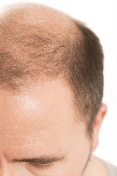 Calvície Alopecia Homem Queda Cabelo Cuidados Com Cabelos Medicina Tratamento — Fotografia de Stock