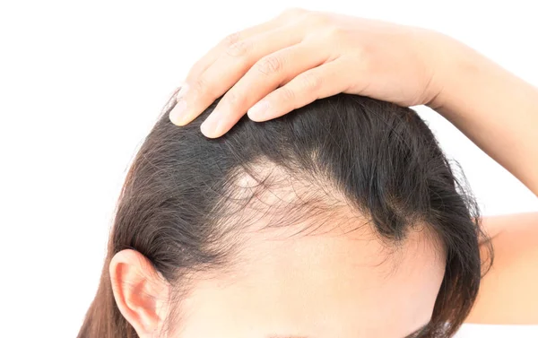Woman Serious Hair Loss Problem Health Care Shampoo Beauty Product — Stock Photo, Image