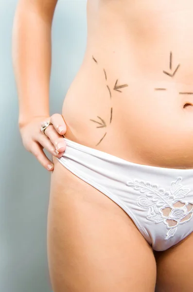 Foto Primer Plano Del Abdomen Una Mujer Caucásica Marcada Con — Foto de Stock