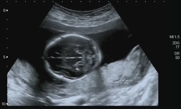 Ultrasonografia Popoporodowa Płodu Czwartego Miesiąca — Zdjęcie stockowe