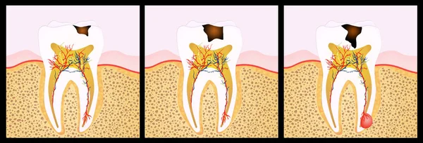 illustration of tooth decay scheme