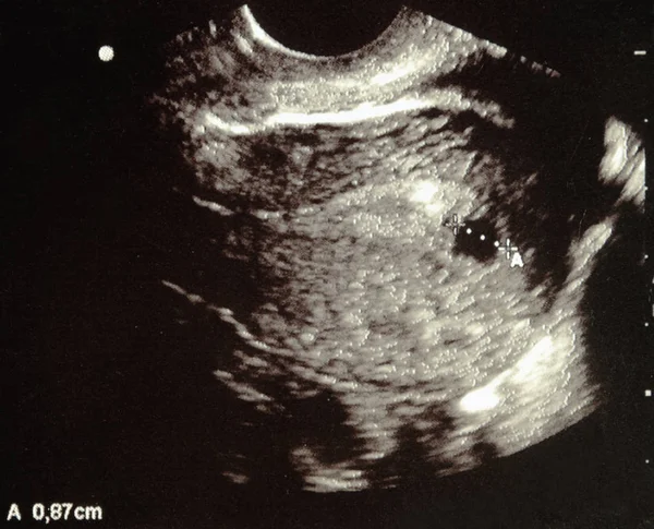 Usg Podczas Ciąży Szóstym Tygodniu — Zdjęcie stockowe