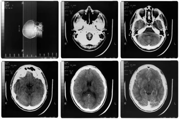 Imaging Medico Raggi Ossa Del Cranio Del Cervello Umano — Foto Stock