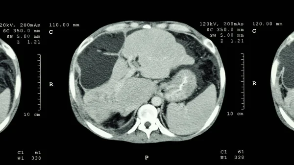 Abdômen Superior Mostrar Massa Anormal Fígado Câncer Fígado — Fotografia de Stock