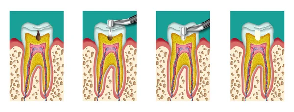 Zubní Kaz Zubního Intervence Vrtací Čtyři Kroky — Stock fotografie