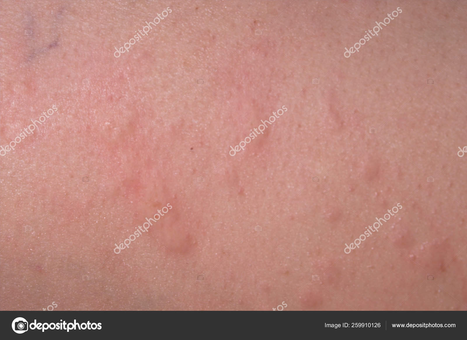 Allergic Reaction Causeing Severe Case Hives Stock Photo By C Yayimages