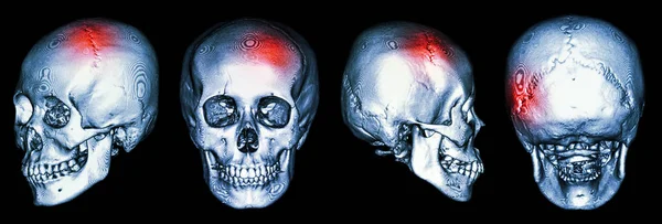 Tac Del Cranio Umano Con Ictus Incidente Cerebrovascolare — Foto Stock