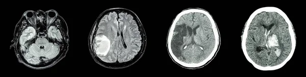 Kolekce Scan Mozku Více Onemocnění Leva Prava Normální Mozku Nádor — Stock fotografie