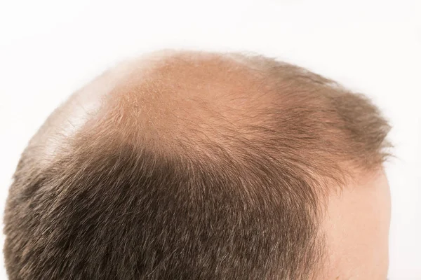 Calvicie Alopecia Hombre Pérdida Cabello Cuidado Del Cabello Medicina Tratamiento — Foto de Stock