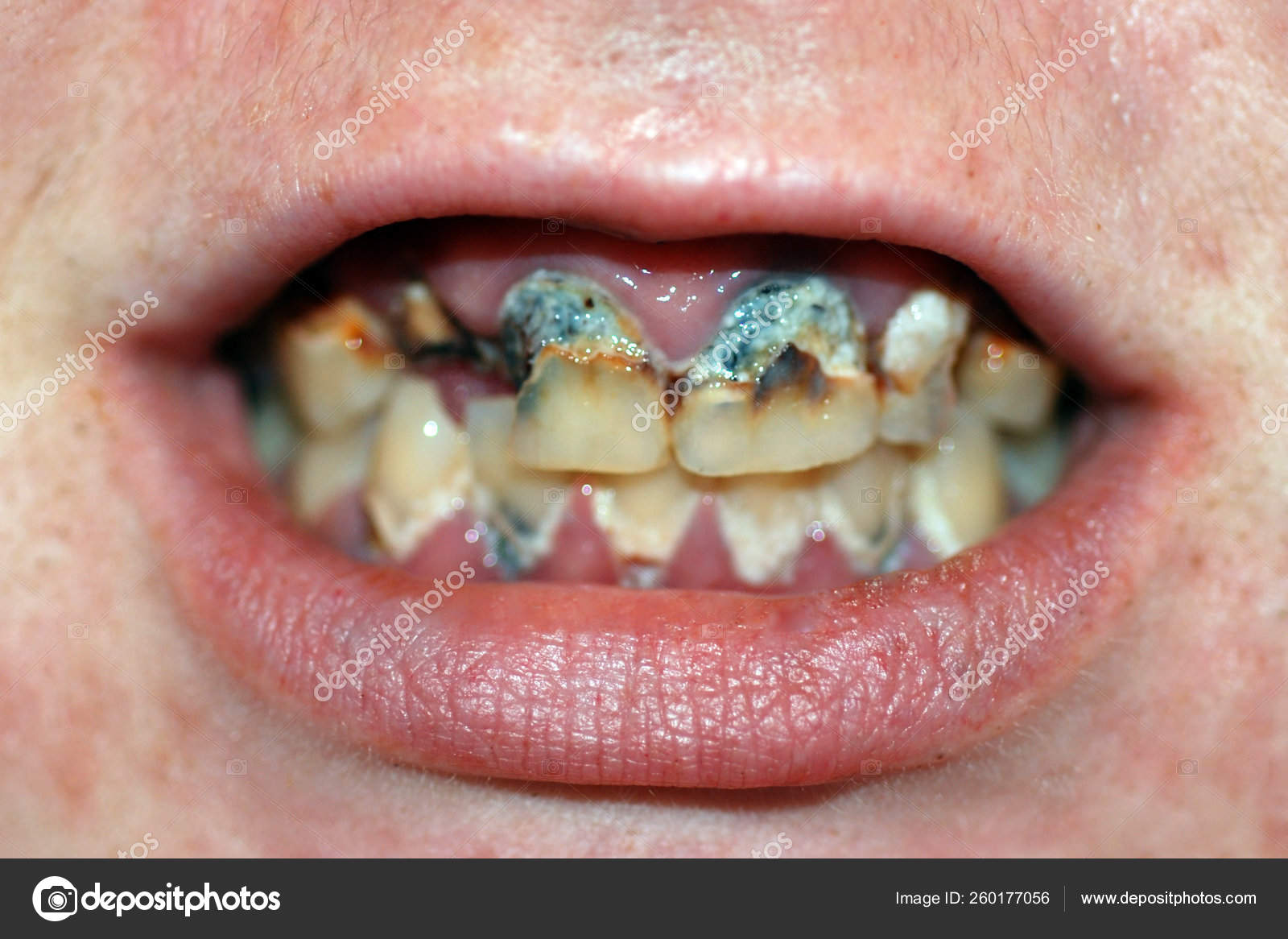 Mouth Extremely Bad Tooth Decay Dental Caries Stock Photo by ©YAYImages  260177056