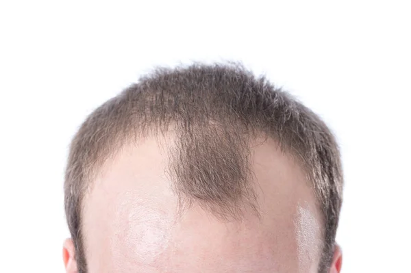 Белый Мужчина Каштановыми Волосами Отступающими Белом Фоне — стоковое фото