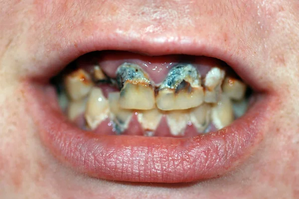Mund Med Ekstremt Dårlig Tandforfald Tandkaries - Stock-foto