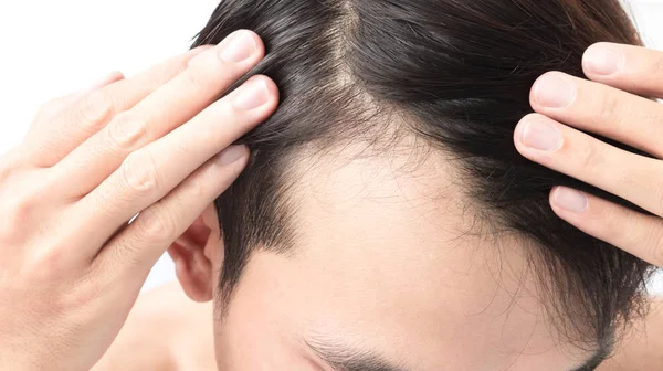 Young Man Serious Hair Loss Problem Health Care Shampoo Beauty — Stock Photo, Image