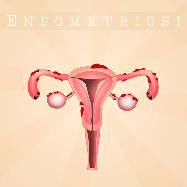 Illustration Der Endometriosekrankheit Mit Inschrift — Stockfoto