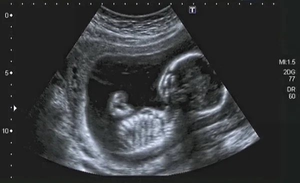 Υπερηχογραφία Ανάλυση 4Ου Μήνα Έμβρυου Ιταλία — Φωτογραφία Αρχείου