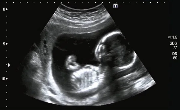 Ultraschalluntersuchung Eines Fetus Monat Italien — Stockfoto