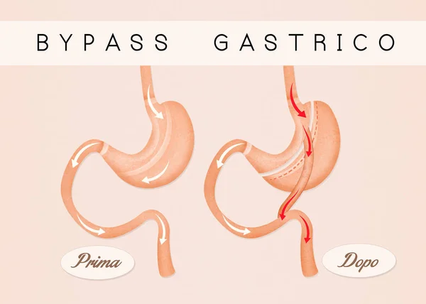 Ilustração Antes Depois Bypass Gástrico — Fotografia de Stock