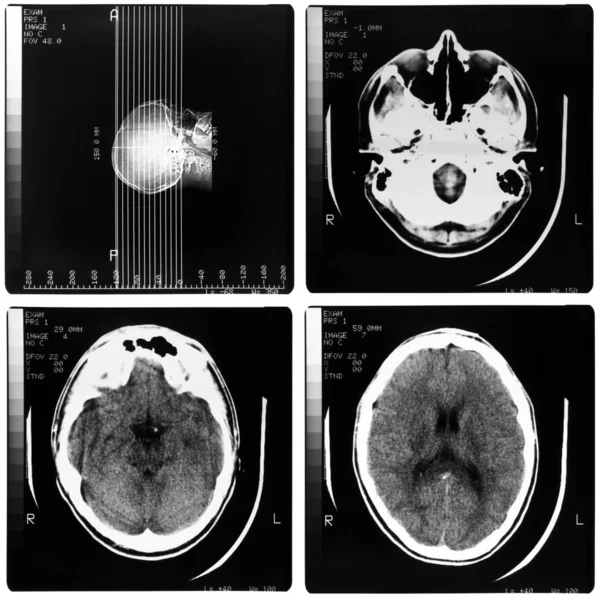Imaging Medico Raggi Ossa Del Cranio Del Cervello Umano — Foto Stock