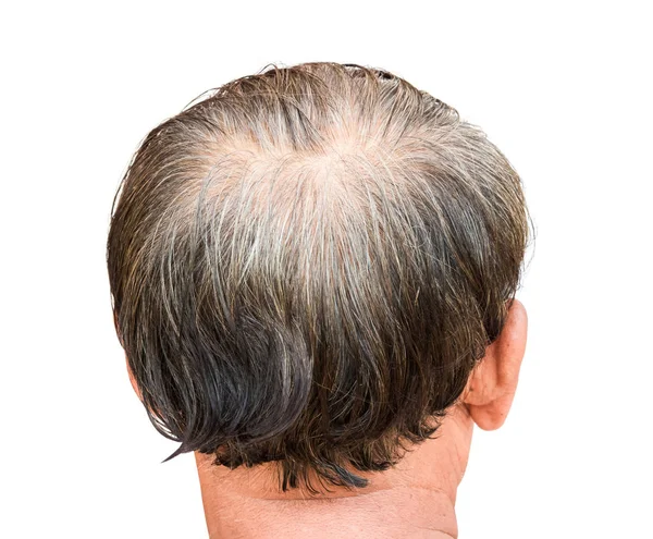 Primer Plano Viejo Hombre Seria Pérdida Cabello Problema Pelo Gris — Foto de Stock