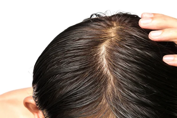 Closeup Young Man Serious Hair Loss Problem Hair Loss Concept — Stock Photo, Image