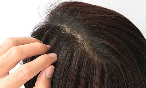 Tânărul Problemă Serioasă Cădere Părului Pentru Șampon Îngrijire Sănătății Conceptul — Fotografie, imagine de stoc