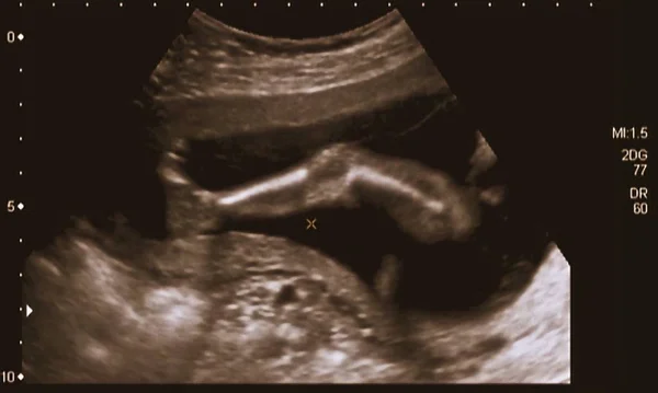 Ultraschalluntersuchung Eines Fetus Monat Italien — Stockfoto