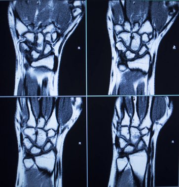 MRI magentic resonance imaging nuclear scanning scan test results wrists hands injury photo. clipart
