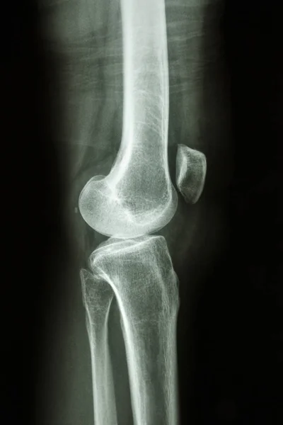 Raio Flim Lateral Joelho Mostrar Articulação Normal Joelho Humano — Fotografia de Stock