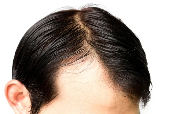 Primer Plano Joven Serio Problema Pérdida Cabello Para Concepto Pérdida — Foto de Stock