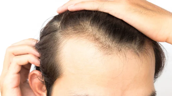 Anak Muda Serius Kehilangan Rambut Masalah Untuk Kesehatan Sampo Dan — Stok Foto