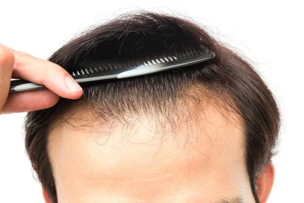 Primer Plano Joven Serio Problema Pérdida Cabello Para Concepto Pérdida — Foto de Stock